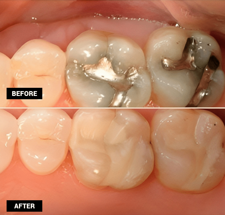 Dental filling
