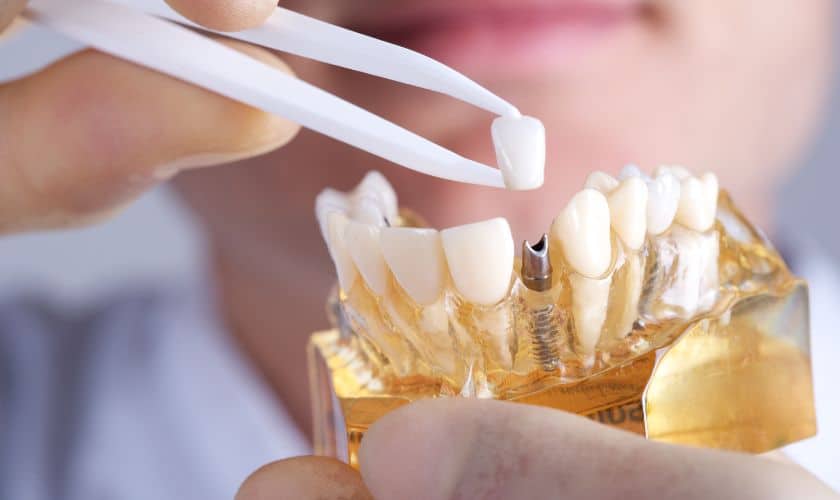Benefits of Dental Implants in Bowling Green, KY