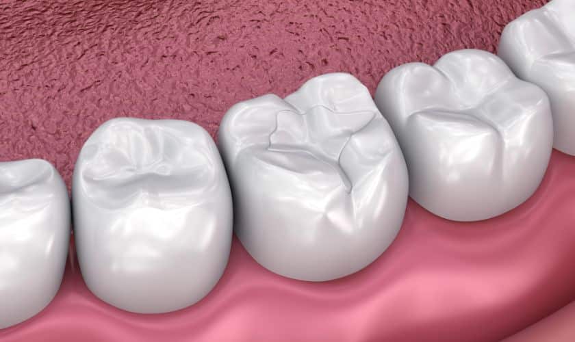 Fillings for Tooth Protection