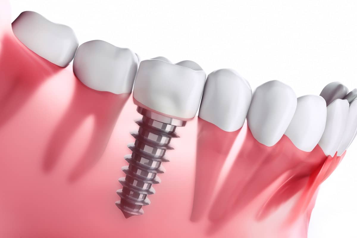 5 Facts You Should Know About Dental Implants