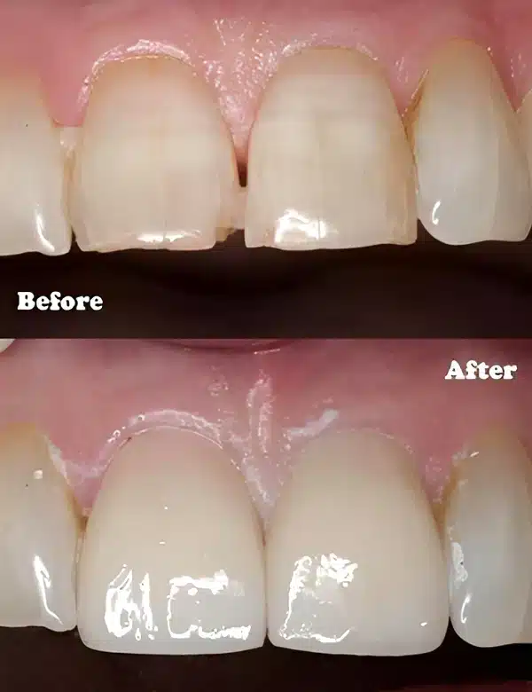 Dental Crowns Bowling Green