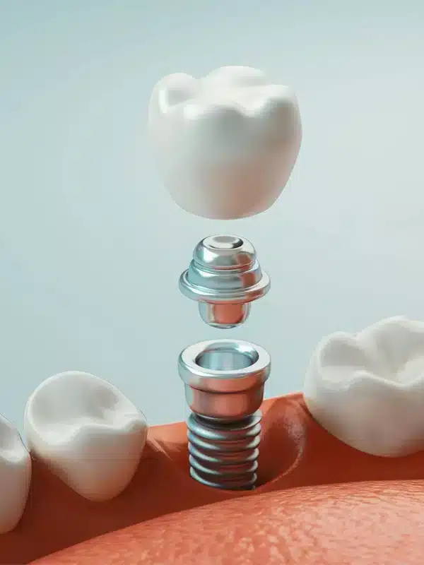 Dental Implants Bowling Green
