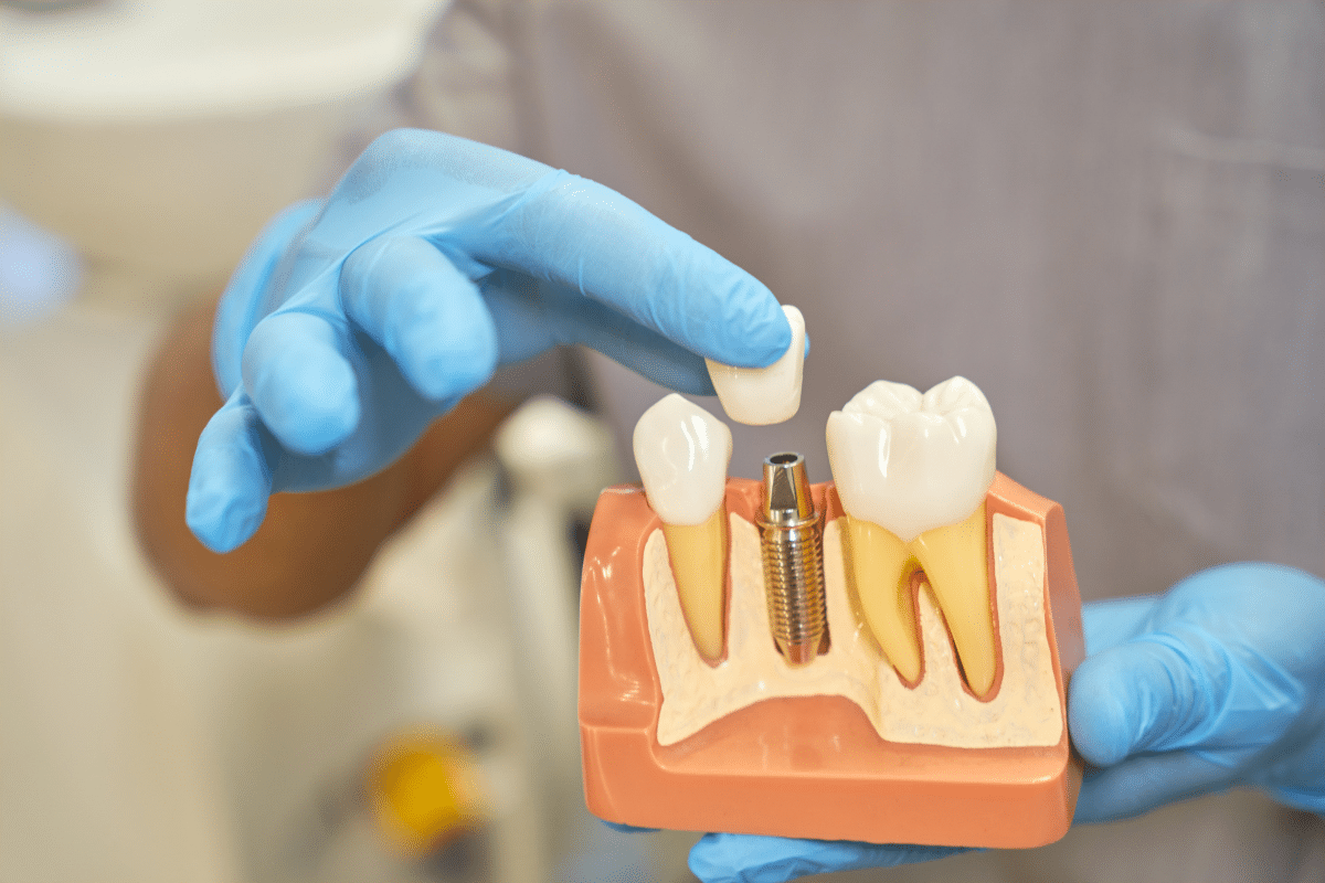 Dental Implants to restore your smile